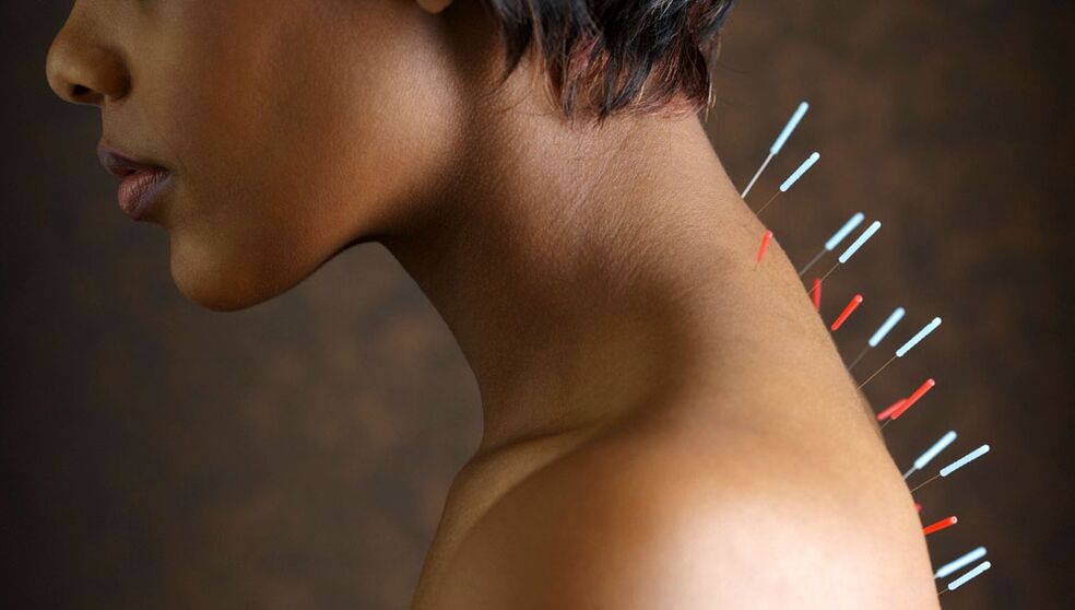 Akupunktura z osteochondozą szyjną