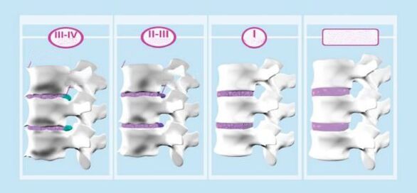 Etapy osteochondrozy szyjnej