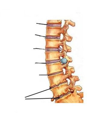 Jak rozwija się osteochondroza