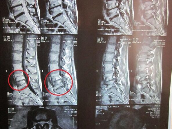 Rozpoznanie osteochondrozy szyjki macicy