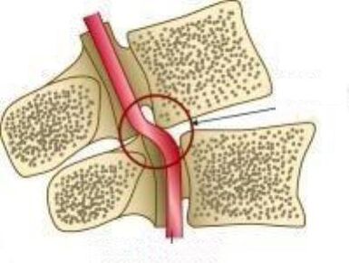 Zespół tętnicy Vail