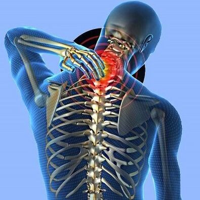 ból szyi z osteochondrozą szyjną