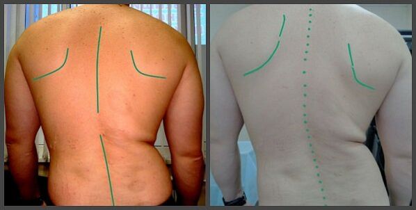 krzywizna kręgosłupa z osteochondozą