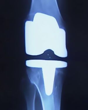 X -Ray Zdjęcie kolana ze sztuczną protezą po operacji zmiany stawu