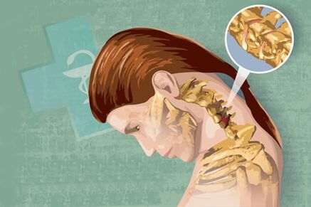 Odruchowe objawy osteochondozy